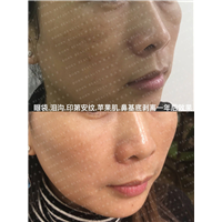 泪沟眼袋印第安纹苹果肌鼻基底剥离一年后效果