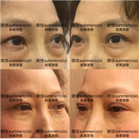 眼袋泪沟剥离