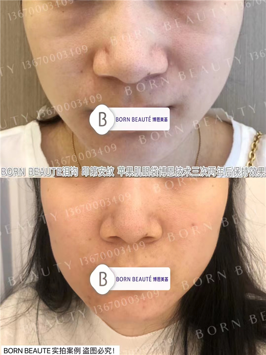 印第安纹剥离是什么？怎么去除印第安纹？