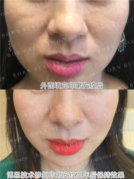 为什么会出现印第安纹？形成原因有哪些？