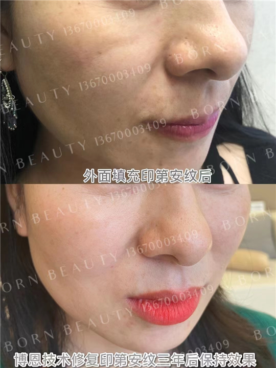 印第安纹剥离效果怎么样？可以维持多久？