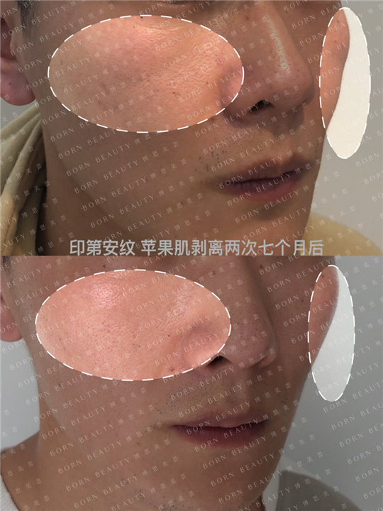 印第安纹苹果肌剥离两次七个月后