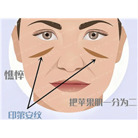 为什么填完苹果肌印第安纹会加深？印第安纹加重与这3点有关