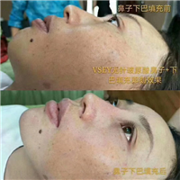 无针医美|无针医美是什么