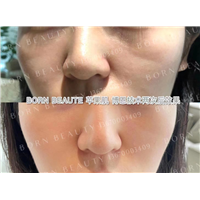 印第安纹填充用什么分子好？印第安纹可以打玻尿酸吗？