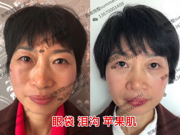 博恩汇美剥离美学祛除眼袋泪沟