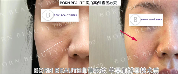 年纪轻轻就出现印第安纹，这是什么情况？