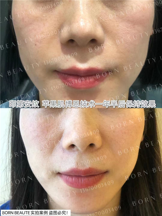 印第安纹怎么去除？这三种方法你会怎么选择？