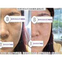 印第安纹剥离技术安全吗？做完之后会产生什么样的效果？