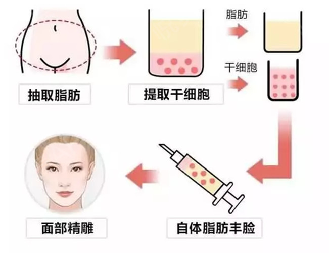 自体脂肪填充印第安纹效果怎么样？有什么风险？