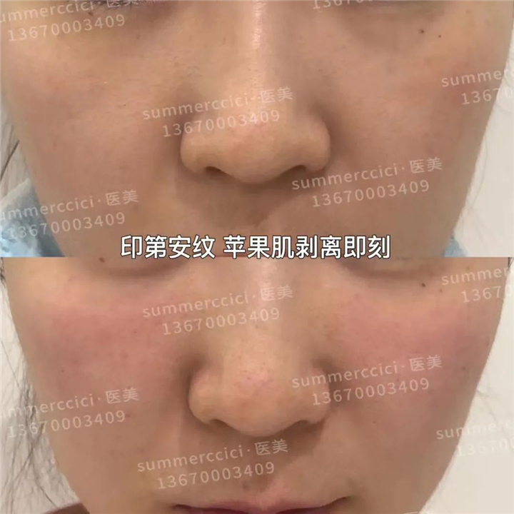 印第安纹剥离技术有风险吗？