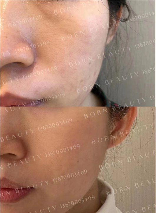 印第安纹如何解决？如何选择性价比高的医美机构？