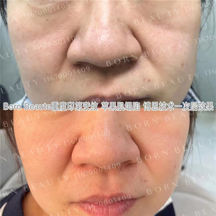 为什么有印第安纹？这种方法能够令印第安纹逐渐淡化掉？