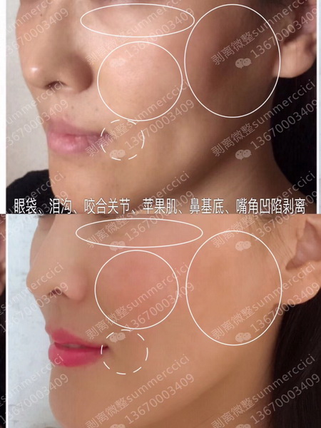 眼袋泪沟咬合关节剥离