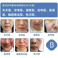 家用美容仪是智商税吗？对印第安纹的去除效果怎么样？