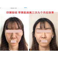 印第安纹苹果肌剥离三次九个月后效果