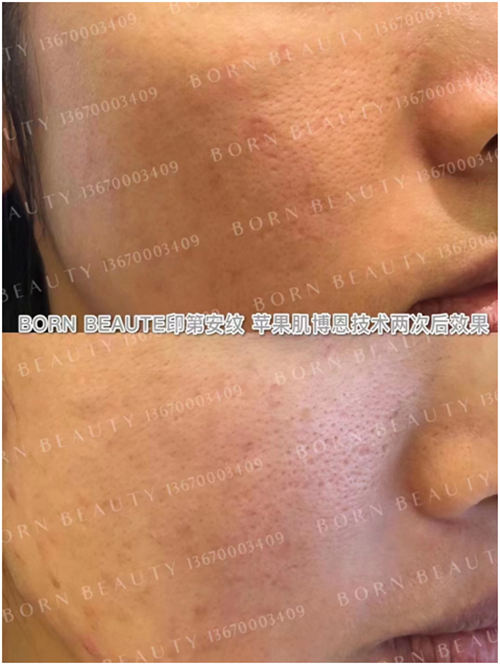 有印第安纹怎么办？要如何改善呢？