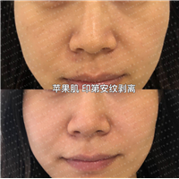 苹果肌印第安纹剥离
