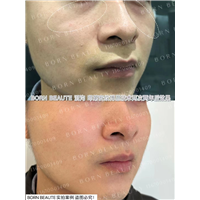 印第安纹怎样才能有效的淡化？只有剥离的方式才管用？