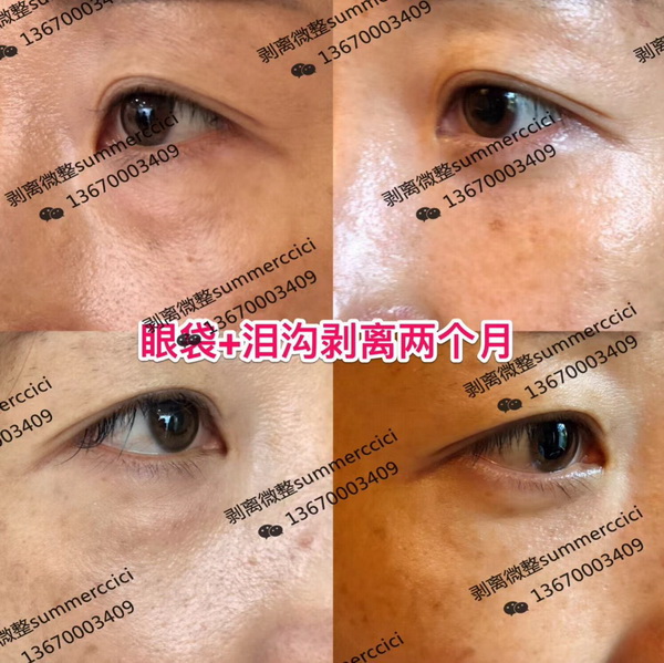 眼袋泪沟剥离两个月