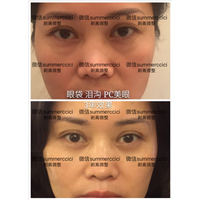 眼袋泪沟pc美眼