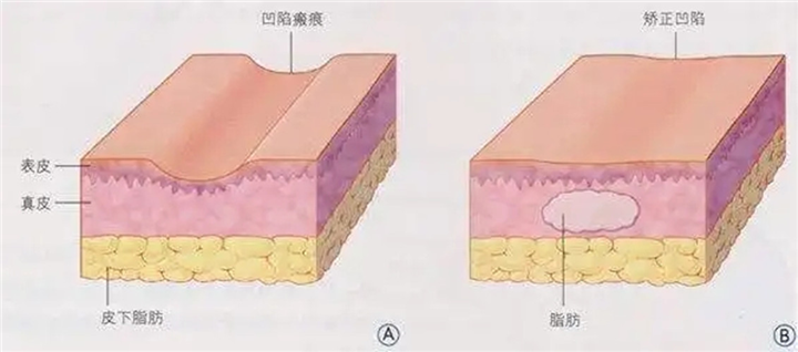印第安纹脂肪填充有效果吗？印第安纹填充可以维持多久？