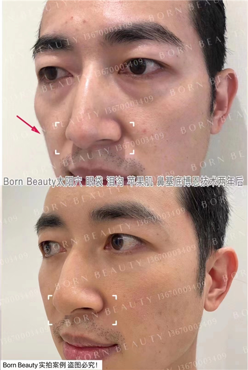 印第安纹怎么改善好？针灸和按   摩有效果吗？