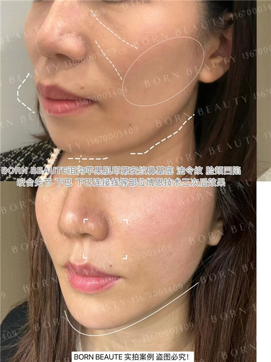 印第安纹按  摩手法管用么？和剥离相比怎么样？