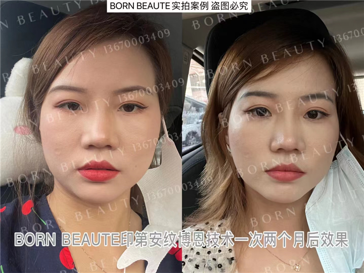 印第安纹怎么才能消除？哪种方法更有效？