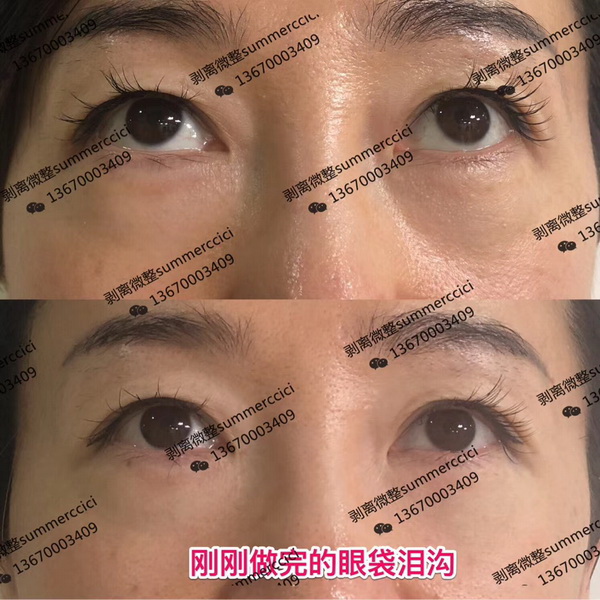 刚刚做完的眼袋泪沟