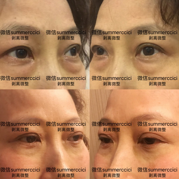 眼袋泪沟剥离