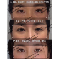 眼袋泪沟眼凹剥离一个月