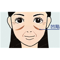 泪沟和印第安纹还有关联？你不会还傻傻分不清吧