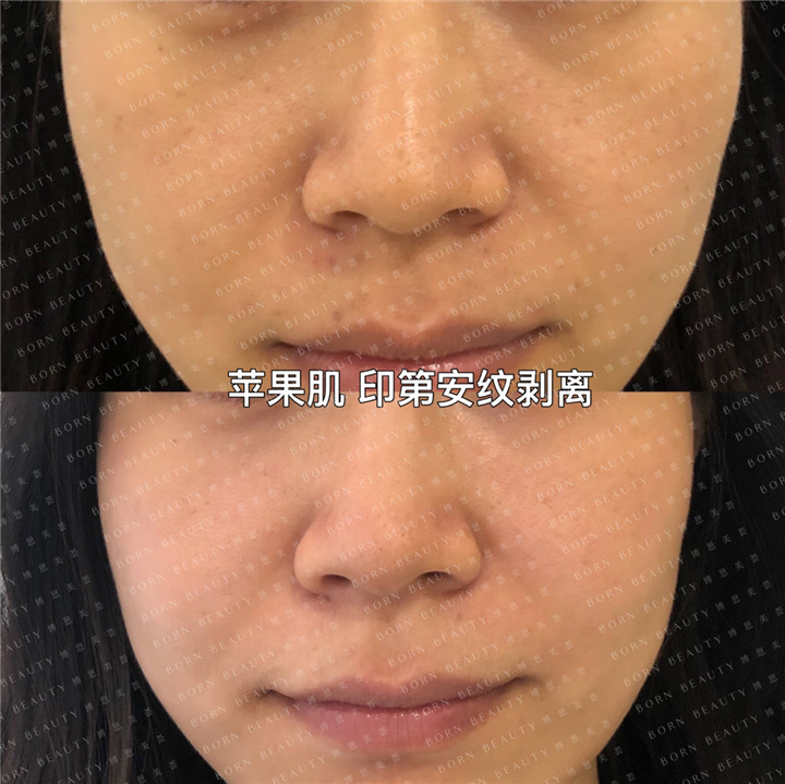 苹果肌印第安纹剥离