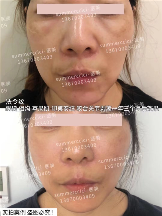 印第安纹会越来越深吗？不去管它会怎么样？