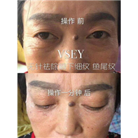 无针医美是什么|VSEY无针微整形培训