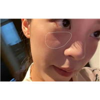 天生的印第安纹如何解决？1个方法帮你告别苦恼