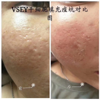 无针医美|无针医美是什么