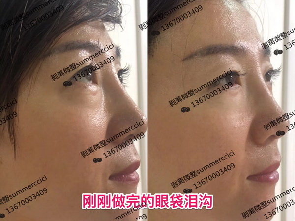 刚刚做完的眼袋泪沟
