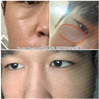 苹果肌印第安纹剥离