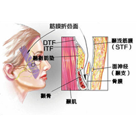 筋膜折叠去除印第安纹效果好吗？印第安纹多久彻底恢复好？