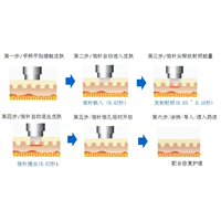 印第安纹剥离其实就是黄金微针？印第安纹剥离是怎么做的？