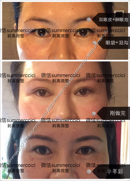 博恩汇美剥离双眼皮