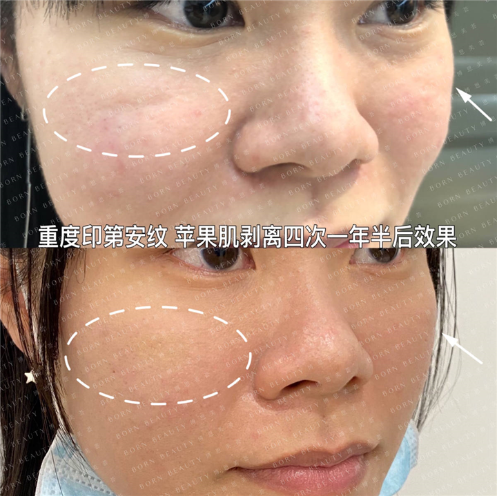 重度印第安纹苹果肌剥离四次一年半后效果