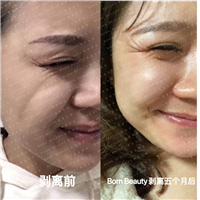 印第安纹剥离五个月后