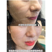 什么是印第安纹？其形成的原因和消除方式有哪些？