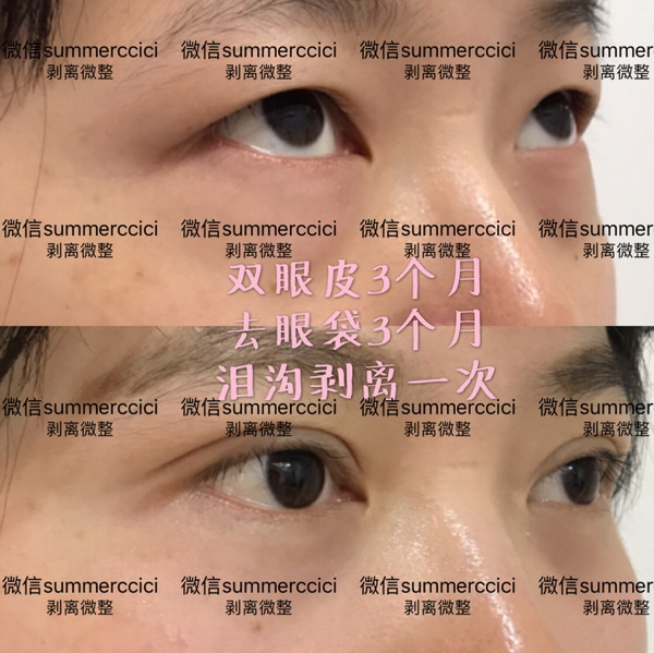 双眼皮三个月