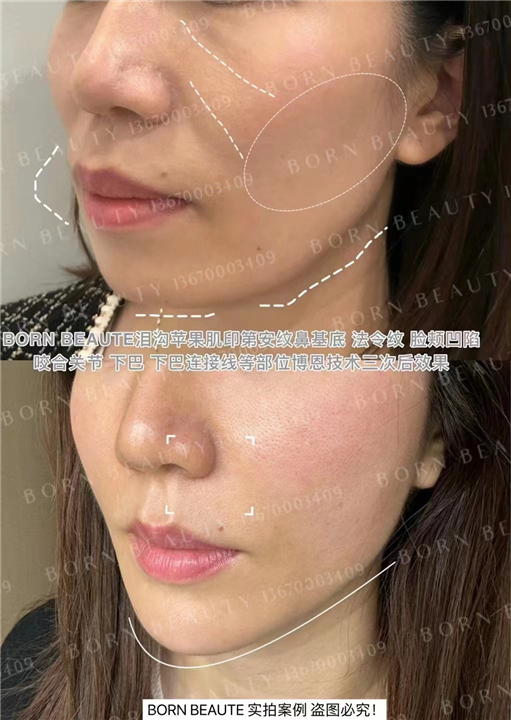 印第安纹怎么去除效果好？消除印第安纹需注意什么？