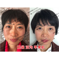 博恩汇美剥离美学祛除眼袋泪沟