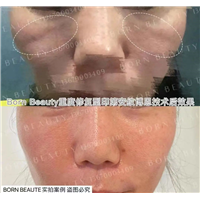 印第安纹祛除效果对比，剥离和填充哪个好？